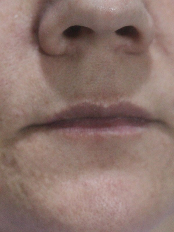Antes — preenchimento labial