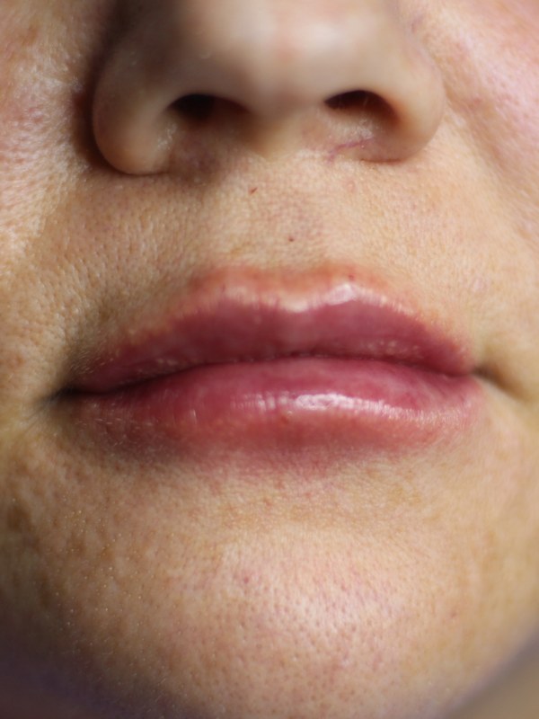 Depois — preenchimento labial