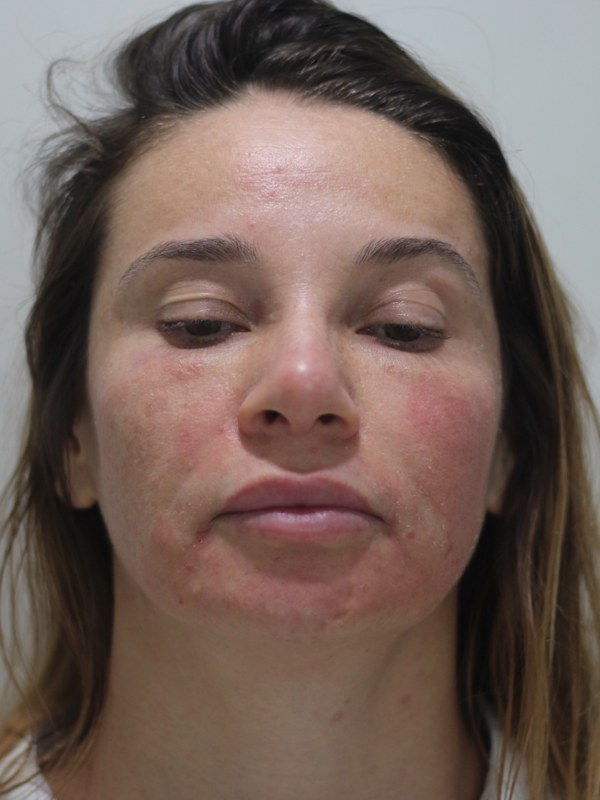 Antes — harmonização facial