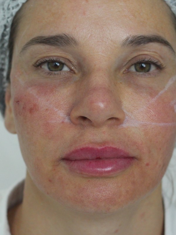 Depois — harmonização facial